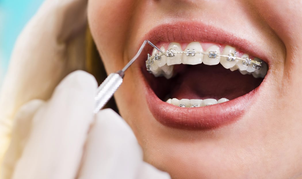 5 Myths About Mouth & Teeth Whitening